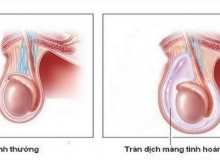 Tràn dịch màng tinh hoàn và cách điều trị hiệu quả